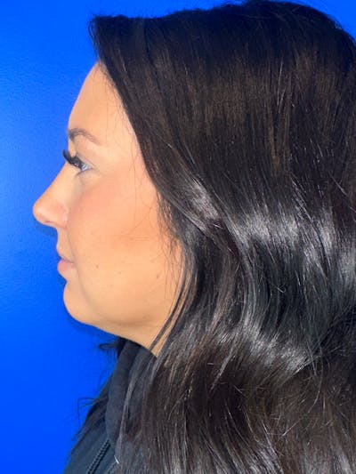 Liquid Rhinoplasty Before & After Gallery - Patient 288829 - Image 2