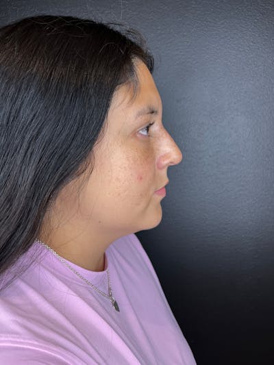 Liquid Rhinoplasty Before & After Gallery - Patient 412426 - Image 2