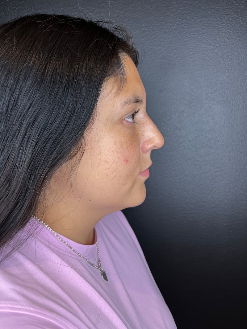 Liquid Rhinoplasty Before & After Gallery - Patient 412426 - Image 2