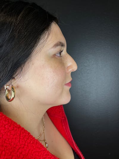 Liquid Rhinoplasty Before & After Gallery - Patient 412426 - Image 1