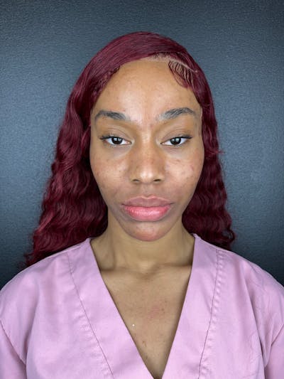 Cheek Filler Before & After Gallery - Patient 107568 - Image 2