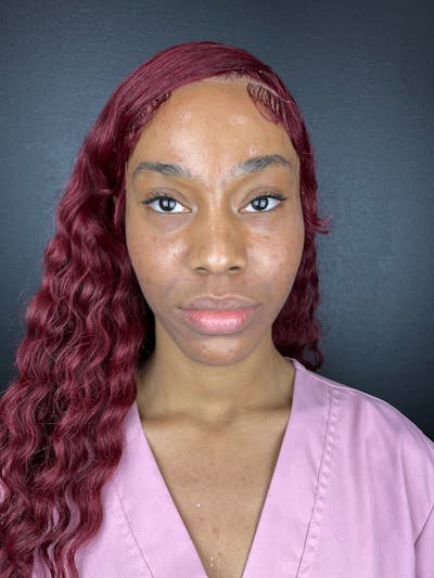 Cheek Filler Before & After Gallery - Patient 107568 - Image 1