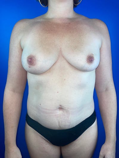 Abdomen (Liposuction) Before & After Gallery - Patient 370537 - Image 1
