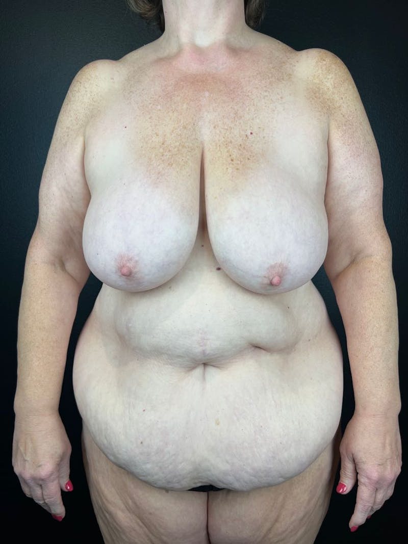 Breast Reduction & Lift Before & After Gallery - Patient 257324 - Image 1