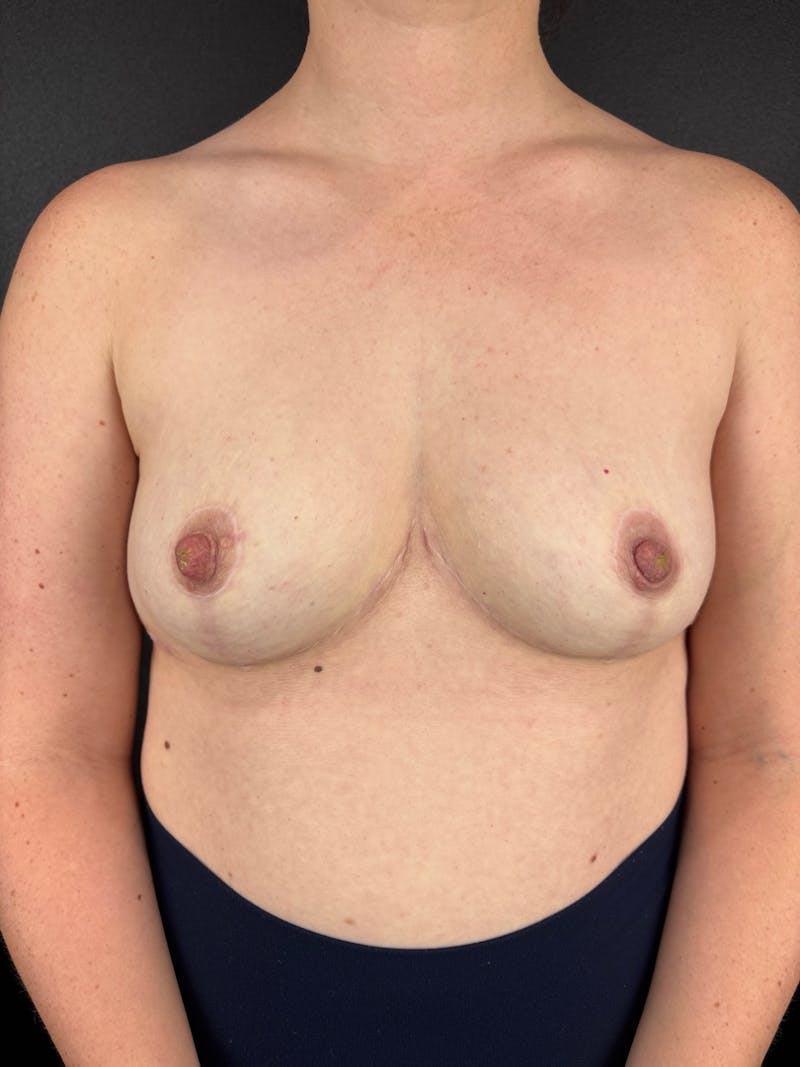 Explant with Breast Lift Before & After Gallery - Patient 100022 - Image 2
