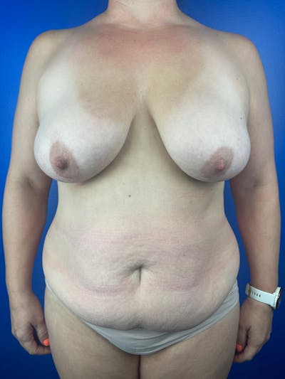 Breast Reduction & Lift Before & After Gallery - Patient 878214 - Image 1