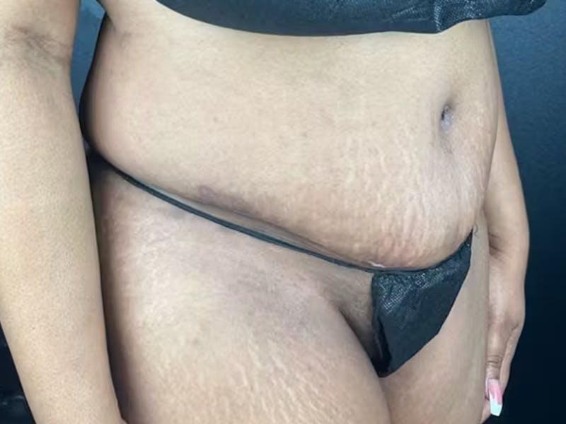 Tummy Tuck Before & After Gallery - Patient 111300 - Image 4