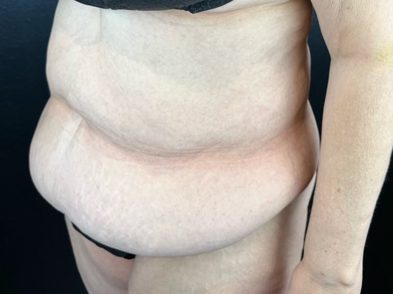 Tummy Tuck Before & After Gallery - Patient 407317 - Image 1