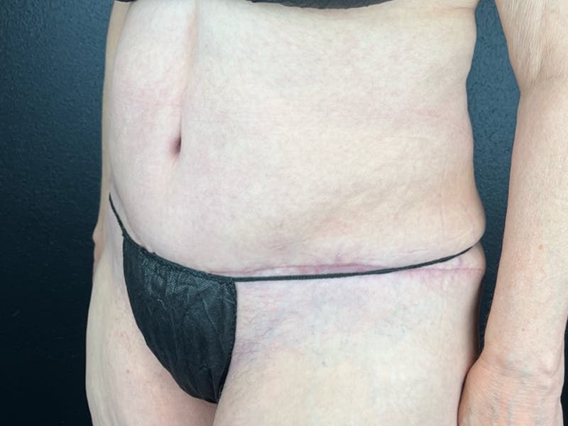 Tummy Tuck Before & After Gallery - Patient 407317 - Image 2