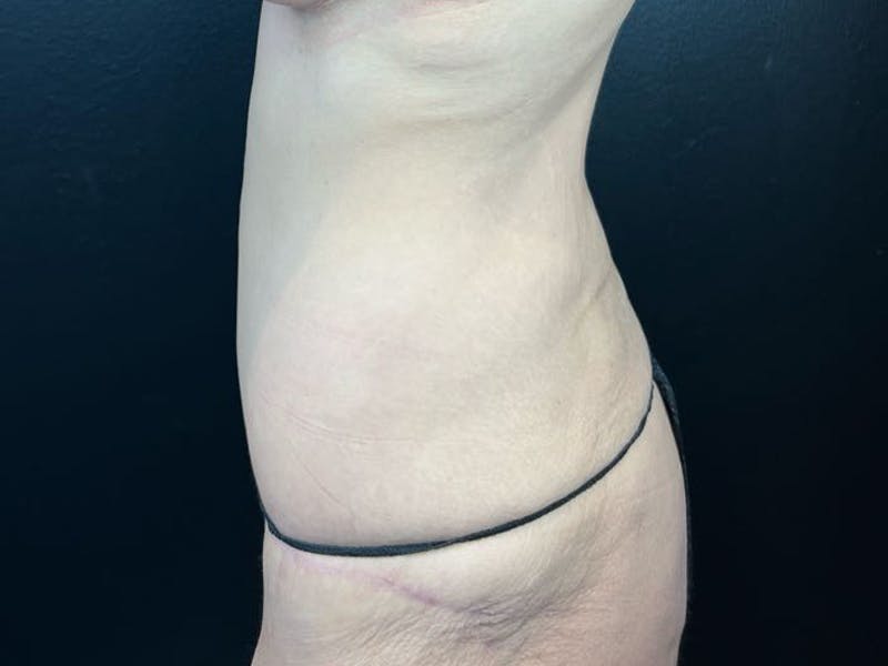 Tummy Tuck Before & After Gallery - Patient 136920 - Image 2