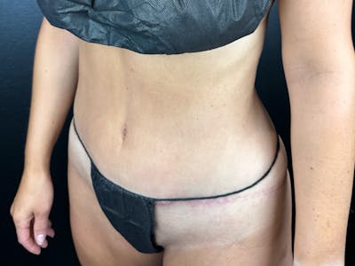 Tummy Tuck Before & After Gallery - Patient 364767 - Image 2