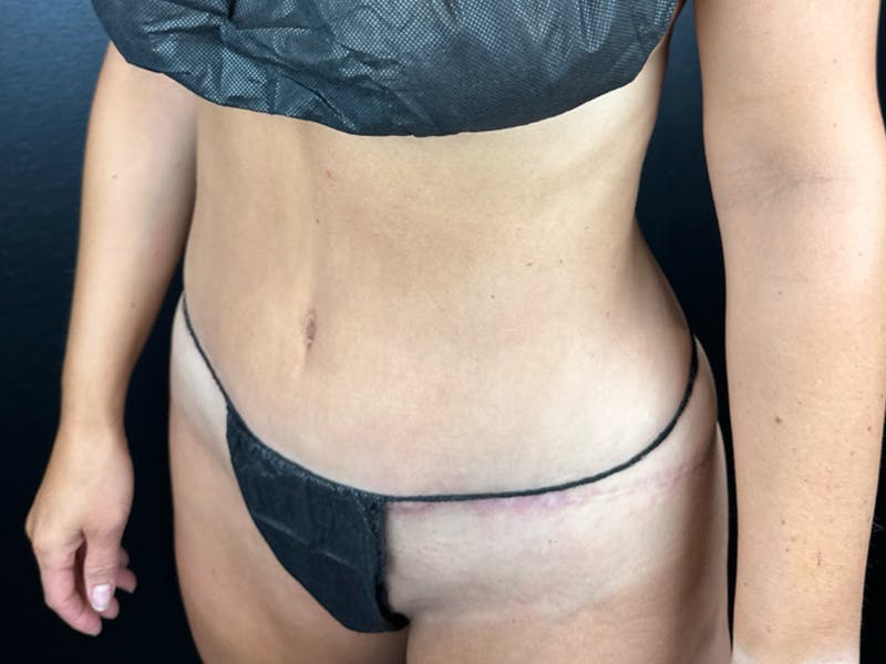 Tummy Tuck Before & After Gallery - Patient 364767 - Image 2