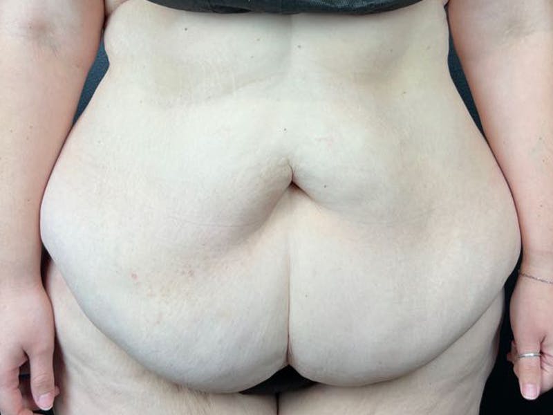 Tummy Tuck Before & After Gallery - Patient 355370 - Image 1