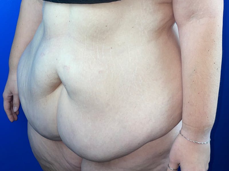 Tummy Tuck Before & After Gallery - Patient 355370 - Image 3