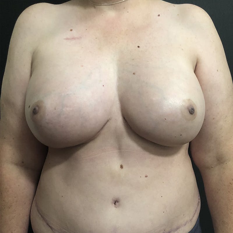 Autologous Tissue Reconstruction Before & After Gallery - Patient 414205 - Image 2