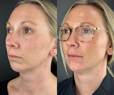 Chin Filler Before & After Gallery - Patient 632529 - Image 1