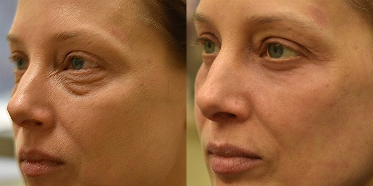 Laser Resurfacing Before & After Gallery - Patient 315726 - Image 3