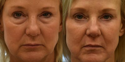 Laser Resurfacing Before & After Gallery - Patient 228549 - Image 1