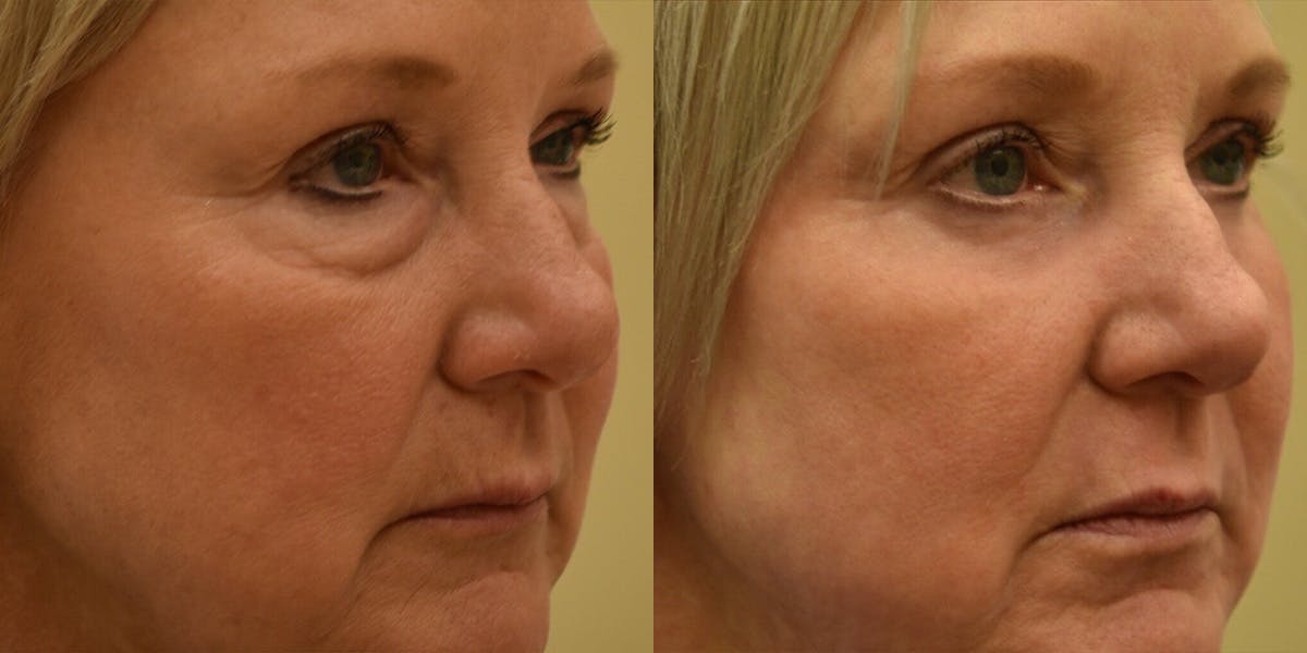 Laser Resurfacing Before & After Gallery - Patient 228549 - Image 2