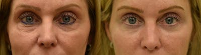 Laser Resurfacing Before & After Gallery - Patient 829087 - Image 1