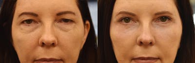 Laser Resurfacing Before & After Gallery - Patient 425746 - Image 1
