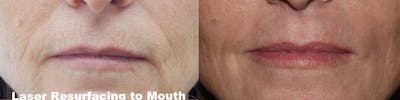 Laser Resurfacing Before & After Gallery - Patient 270563 - Image 1