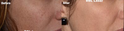 Laser Resurfacing Before & After Gallery - Patient 985587 - Image 1