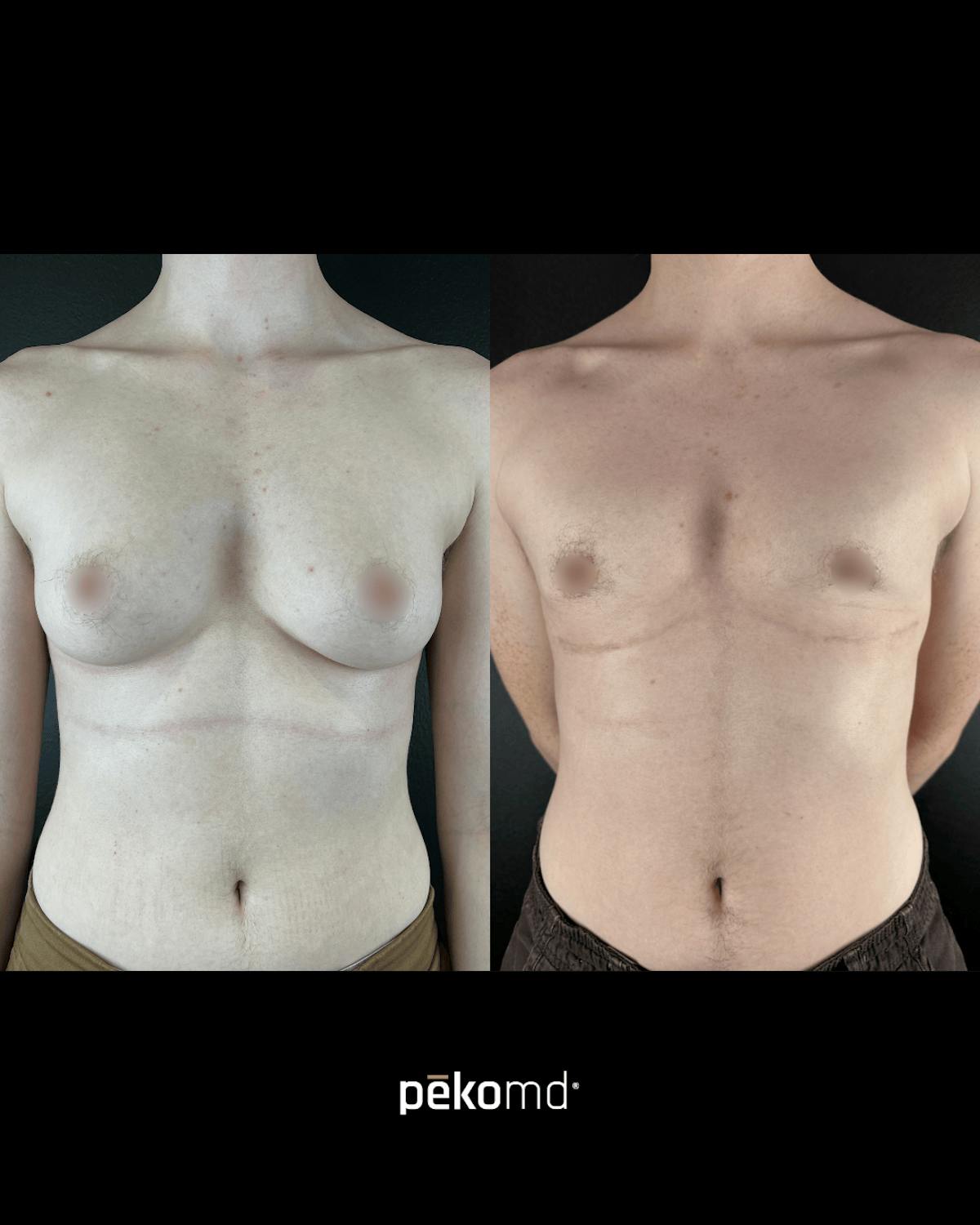 Masculinization Top Surgery (FTM) Before & After Gallery - Patient 222558 - Image 1