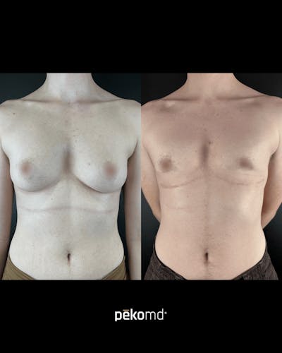 Masculinization Top Surgery (FTM) Before & After Gallery - Patient 222558 - Image 1