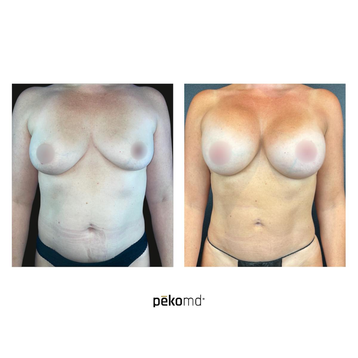 Breast Augmentation Before & After Gallery - Patient 830200 - Image 1