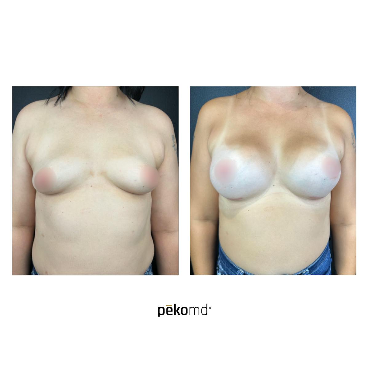 Breast Augmentation Before & After Gallery - Patient 281364 - Image 1