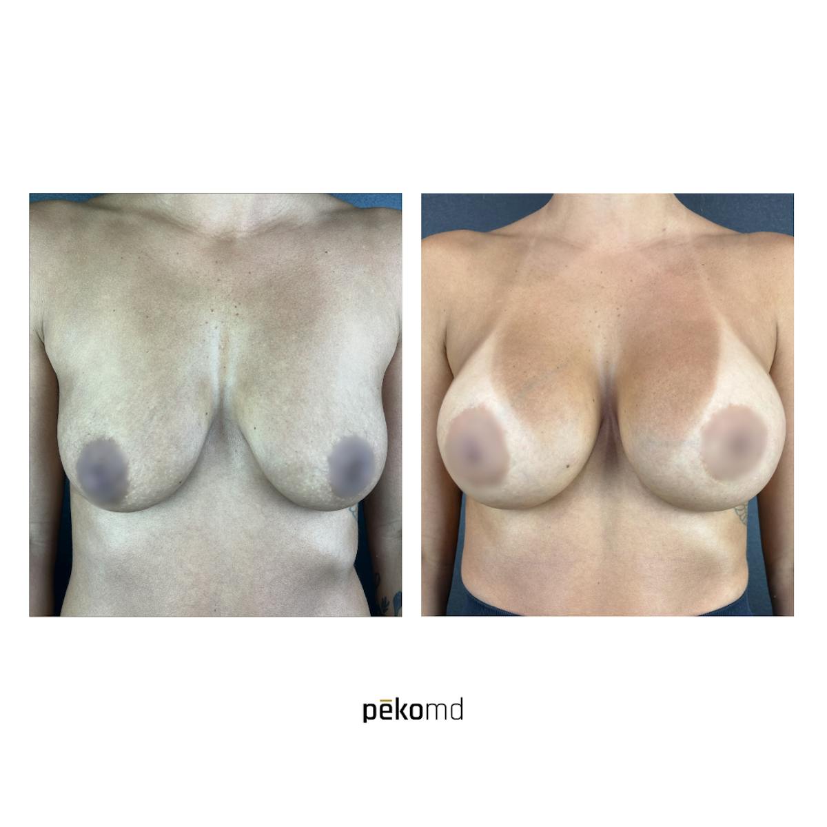 Breast Augmentation Before & After Gallery - Patient 822648 - Image 1