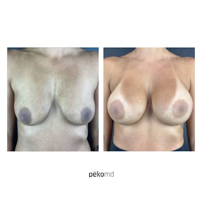 Breast Augmentation Before & After Gallery - Patient 822648 - Image 1