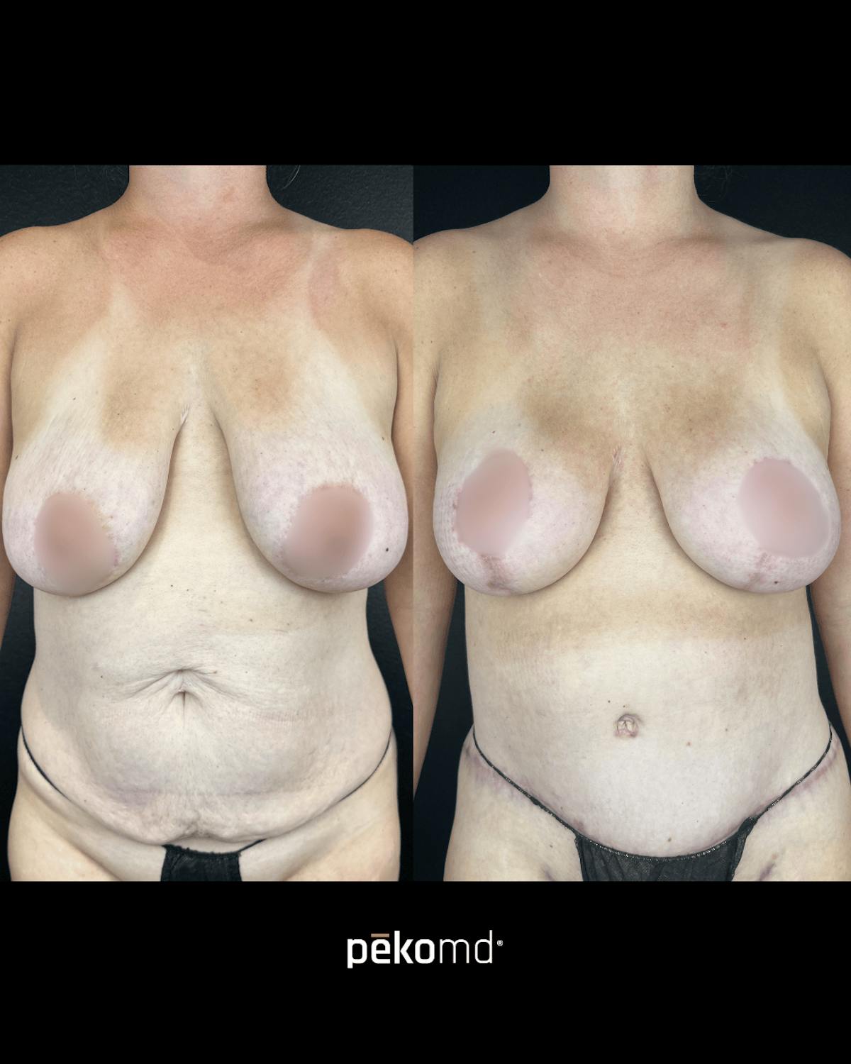 Tummy Tuck Before & After Gallery - Patient 134452 - Image 1