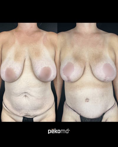 Tummy Tuck Before & After Gallery - Patient 134452 - Image 1
