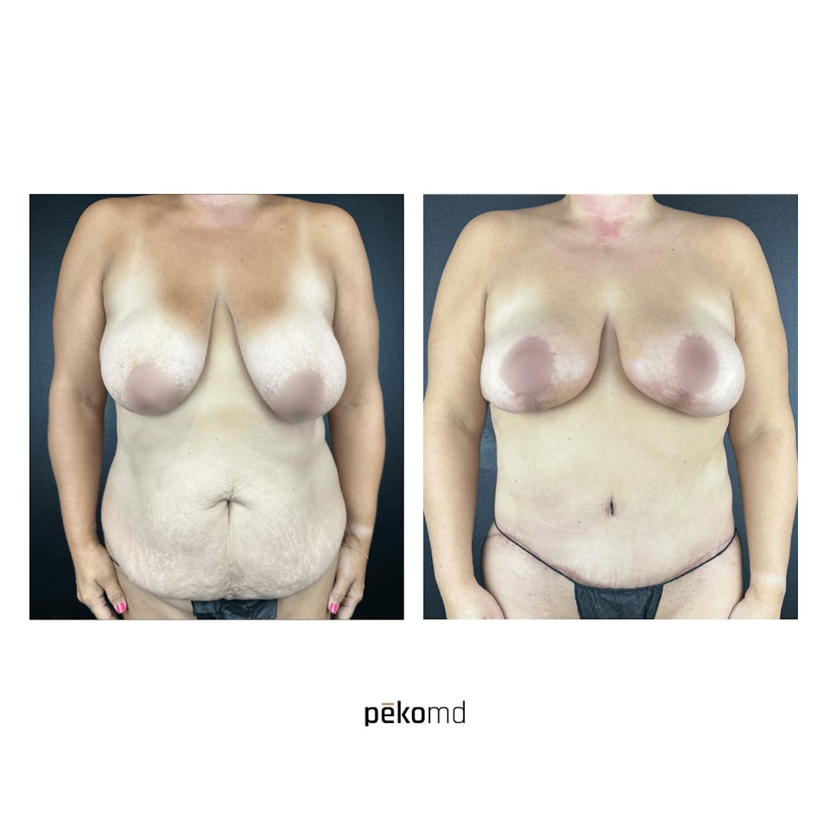 Tummy Tuck Before & After Gallery - Patient 237874 - Image 1