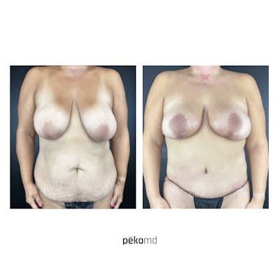 Tummy Tuck Before & After Gallery - Patient 237874 - Image 1