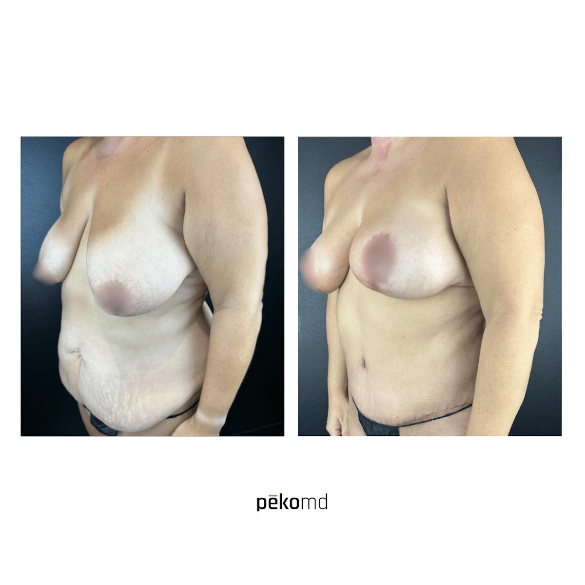 Tummy Tuck Before & After Gallery - Patient 237874 - Image 2