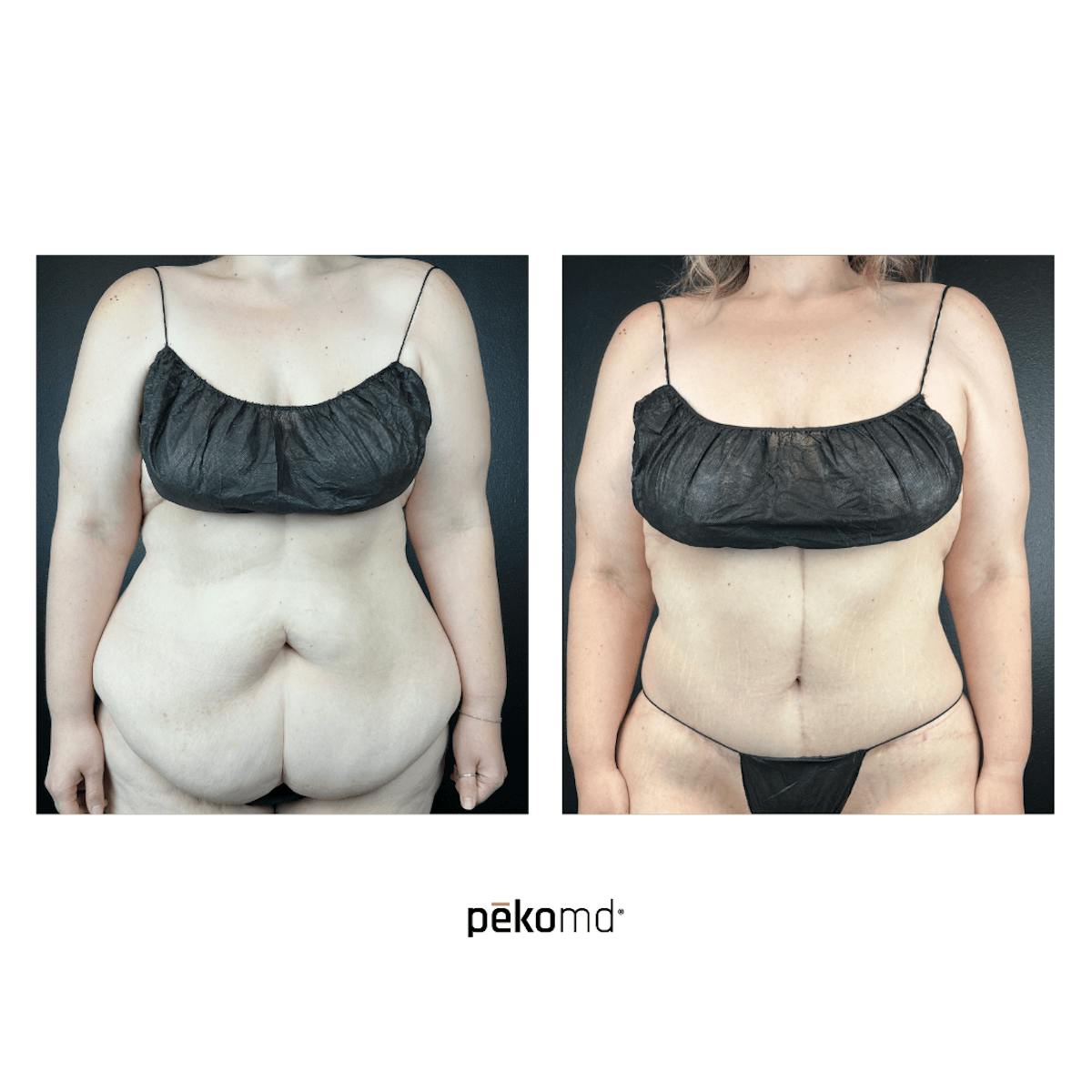 Tummy Tuck Before & After Gallery - Patient 377374 - Image 1