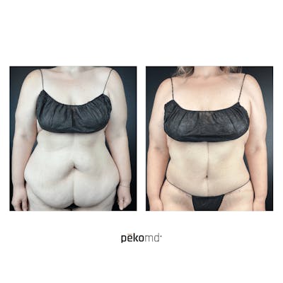 Tummy Tuck Before & After Gallery - Patient 377374 - Image 1