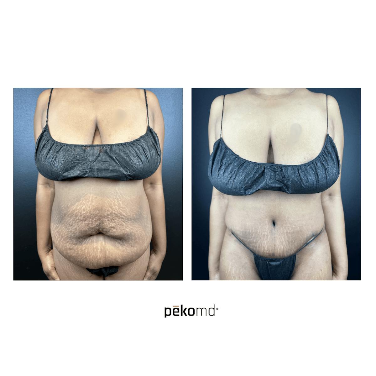 Tummy Tuck Before & After Gallery - Patient 236263 - Image 1