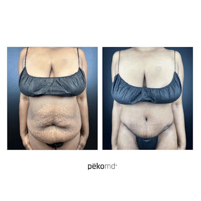 Tummy Tuck Before & After Gallery - Patient 236263 - Image 1