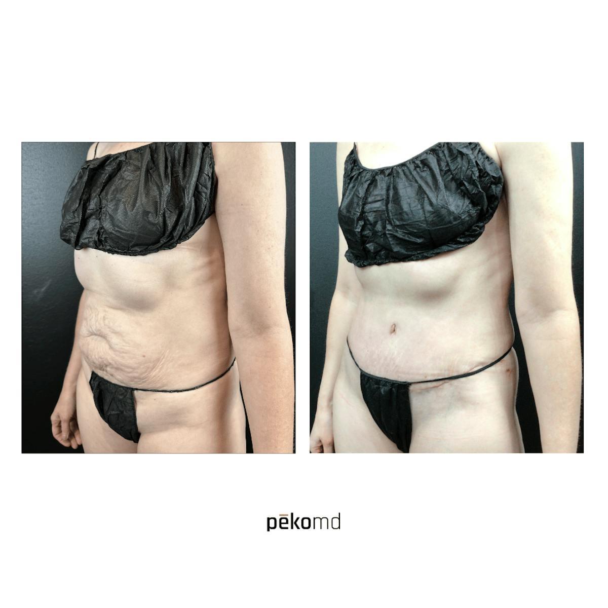Tummy Tuck Before & After Gallery - Patient 175677 - Image 1