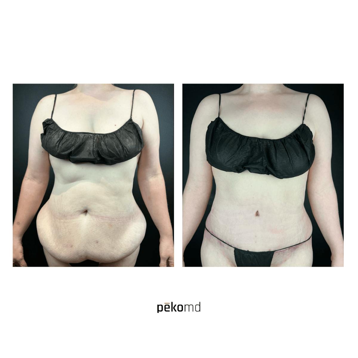 Tummy Tuck Before & After Gallery - Patient 420859 - Image 1