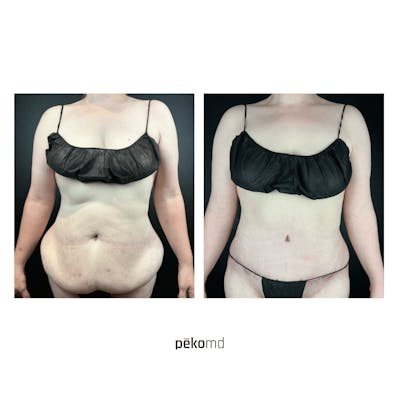 Tummy Tuck Before & After Gallery - Patient 420859 - Image 1
