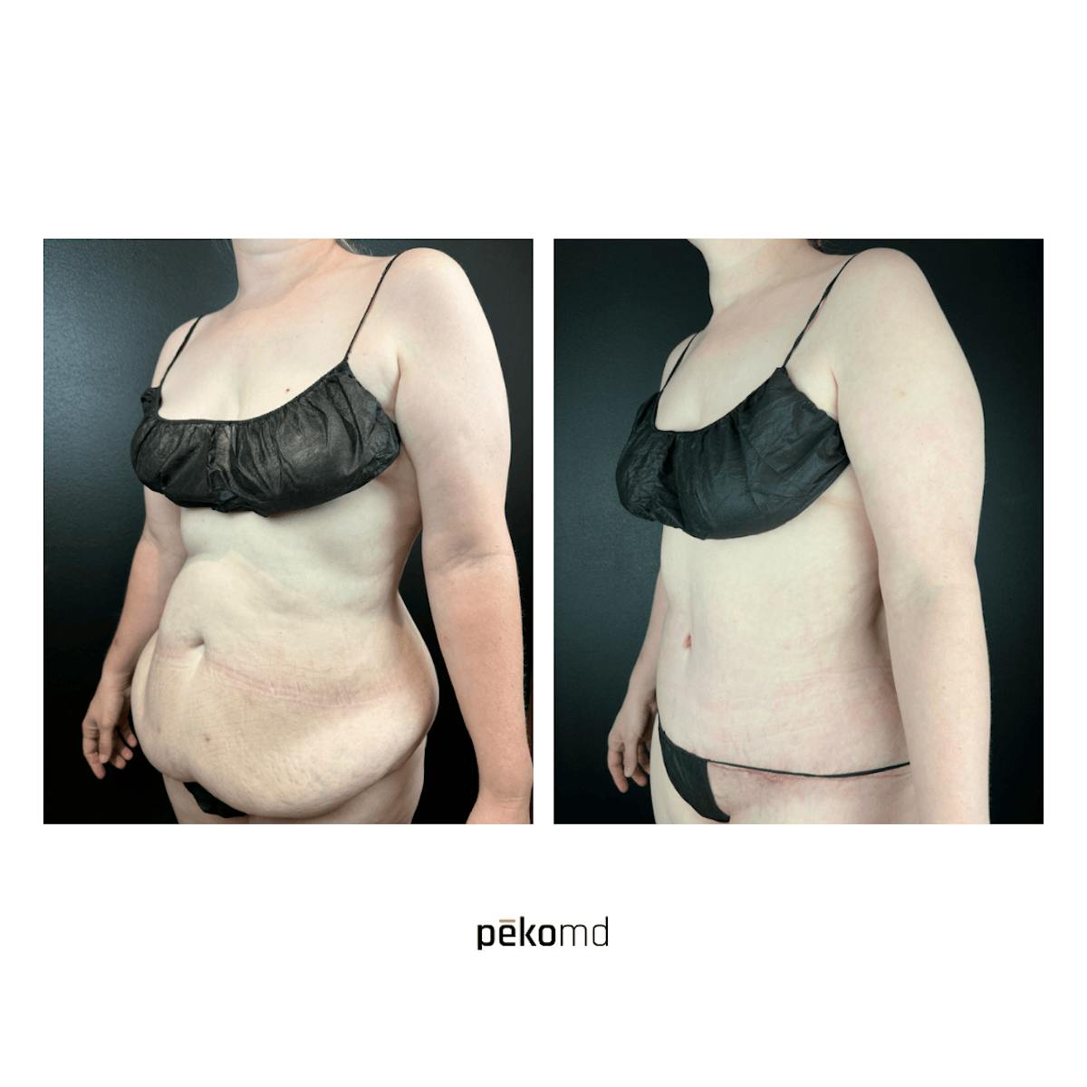Tummy Tuck Before & After Gallery - Patient 420859 - Image 2