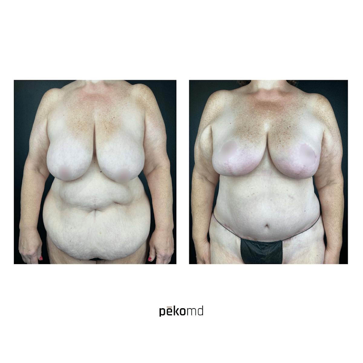 Tummy Tuck Before & After Gallery - Patient 236052 - Image 1