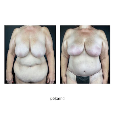 Tummy Tuck Before & After Gallery - Patient 236052 - Image 1