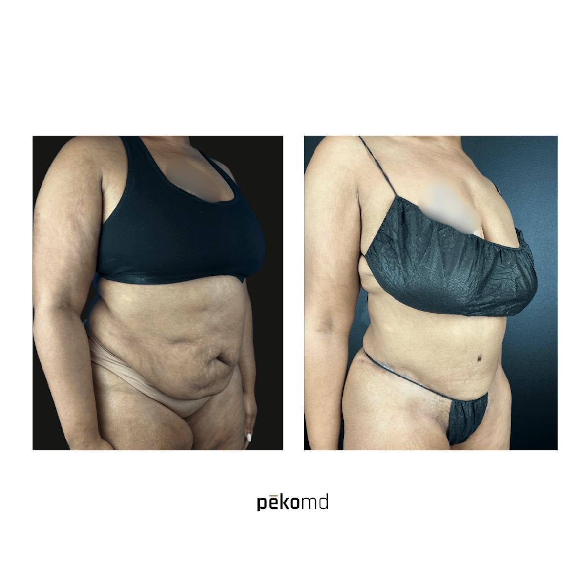 Tummy Tuck Before & After Gallery - Patient 207090 - Image 1