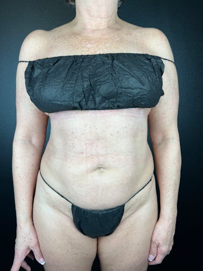 Abdomen (Liposuction) Before & After Gallery - Patient 421371 - Image 2
